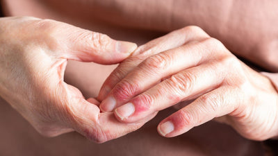 Atooppinen iho: Oireiden helpotus ja luonnolliset tuotteet